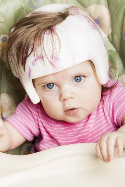 bébé avec prothèse qui présente une plagiocéphalie
