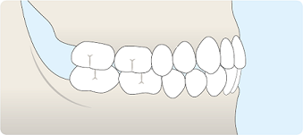 Intervention précoce en orthodontie pédiatrique